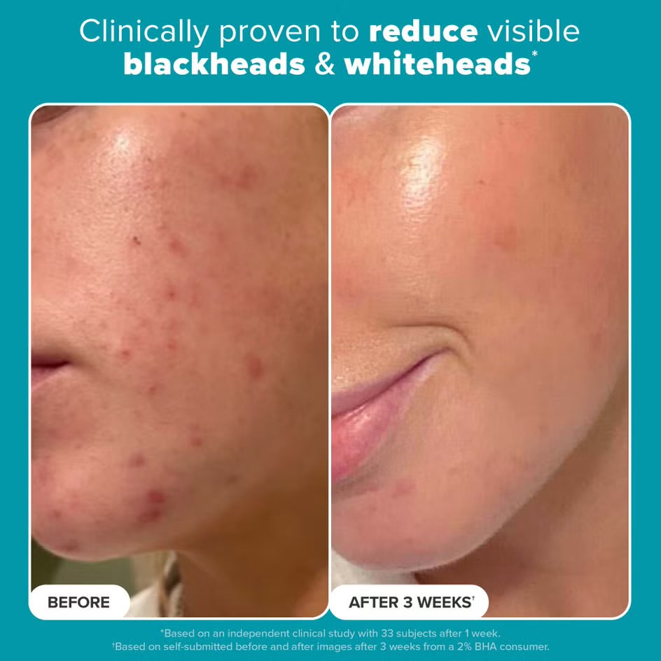 PAULA’S CHOICE 2% BHA Exfoliating Toner